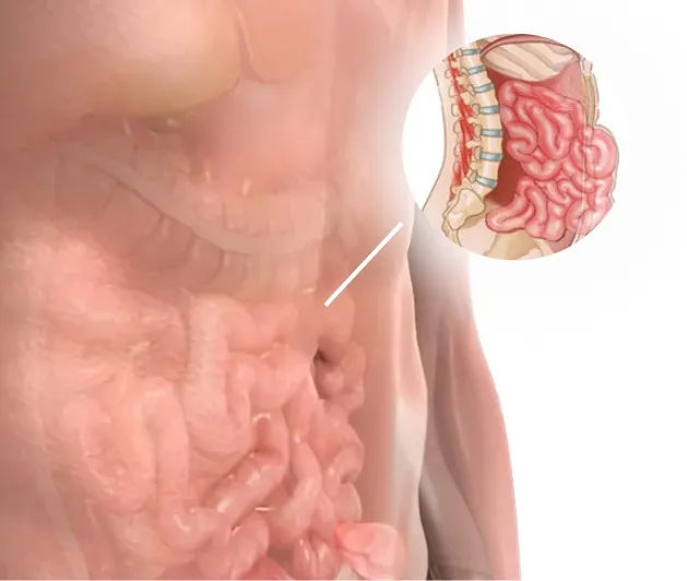 complex hernia